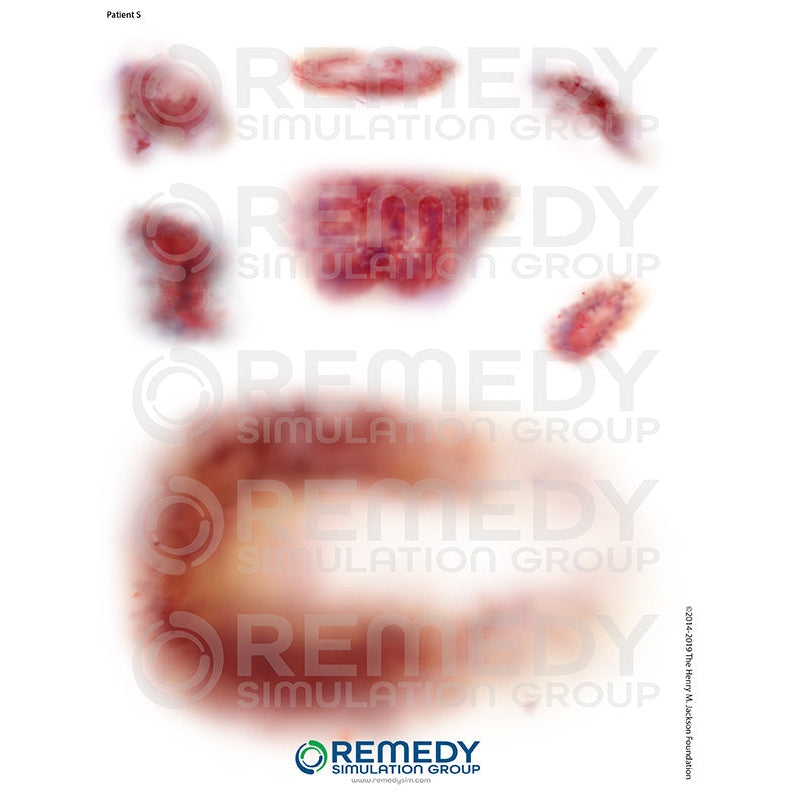 Wallcur-Moulage Tattoos - Patient S Scenario-MedTech-1